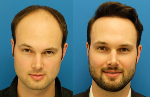 Hair Replacement In Karnataka 8247798712 Mobile No 9951223066 By