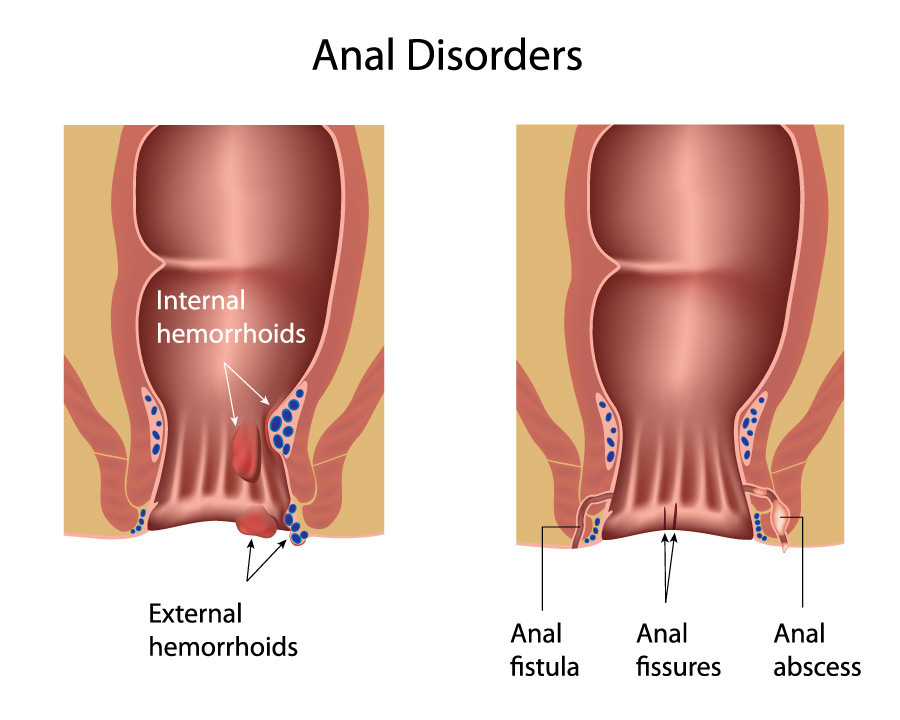 Dr. Abhineet Jain is specialized in Anorectal treatment