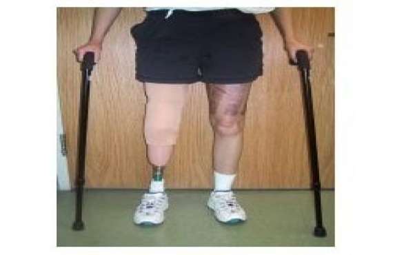 EVOLUTION, Artificial Limb for Below Knee in Hyderabad,Artificial Limb for Below Knee suppliers in Hyderabad,Artificial Limb for Below Knee in vijayawada,Below Knee Artificial Limb manufactur