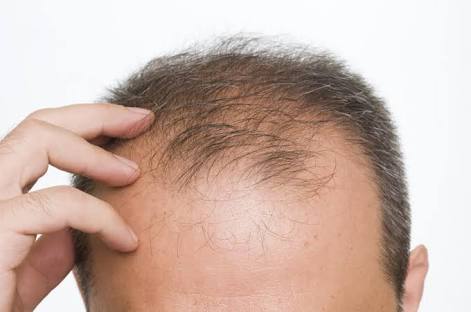 Renovin Skin Care, Hair loss doctor and clinic in Zirakpur and Chandigarh