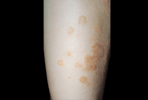 Renovin Skin Care, Skin allergy Doctor Clinic in Zirakpur and Chandigarh
