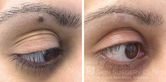 Renovin Skin Care, Laser Removal of Moles, warts and Skin Tags in Zirakpur and Chandigarh