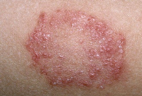Skin allergy treatment in Zirakpur | Renovin Skin Care | Skin Allergy treatment in Zirakpur, Skin care clinic in Zirakpur, Dermatologist in Zirakpur, Skin Doctor in Zirakpur, Skin specialist in Zirakpur - GL79876