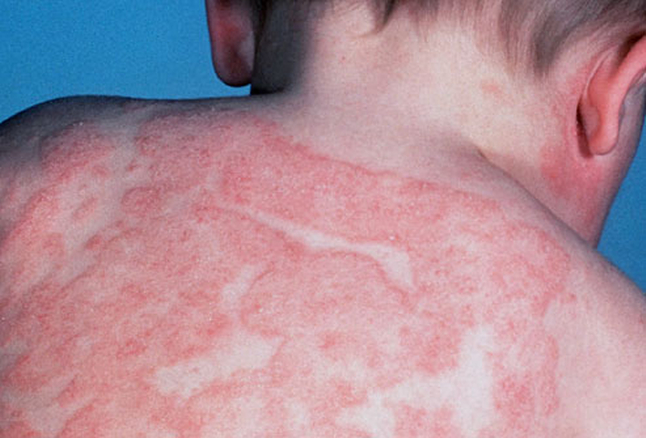 Renovin Skin Care, Eczema Doctor in Zirakpur and Chandigarh