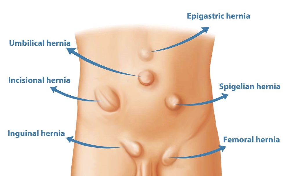 What are the different types of hernia? | Dr. Abhineet Jain (Piles Specialist in Jabalpur) | Incisional Hernia Surgeons in Jabalpur, Abdominal Hernia Surgeons in Jabalpur, Spigelian Hernia Doctors in Jabalpur, Ambulatory Hernia Surgeons in Jabalpur, hernia surgeon in Jabalpur, hernia doctor - GL110481