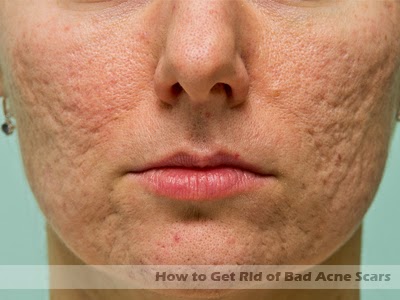 Renovin Skin Care, Acne scars treatment in Zirakpur and Chandigarh
