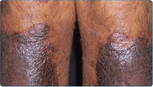 Renovin Skin Care, Psoriasis treatment in Zirakpur and Chandigarh