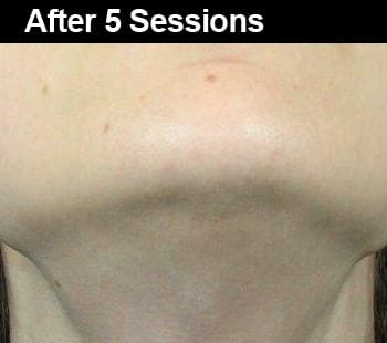 Renovin Skin Care, Permanent Laser Hair Reduction in Zirakpur