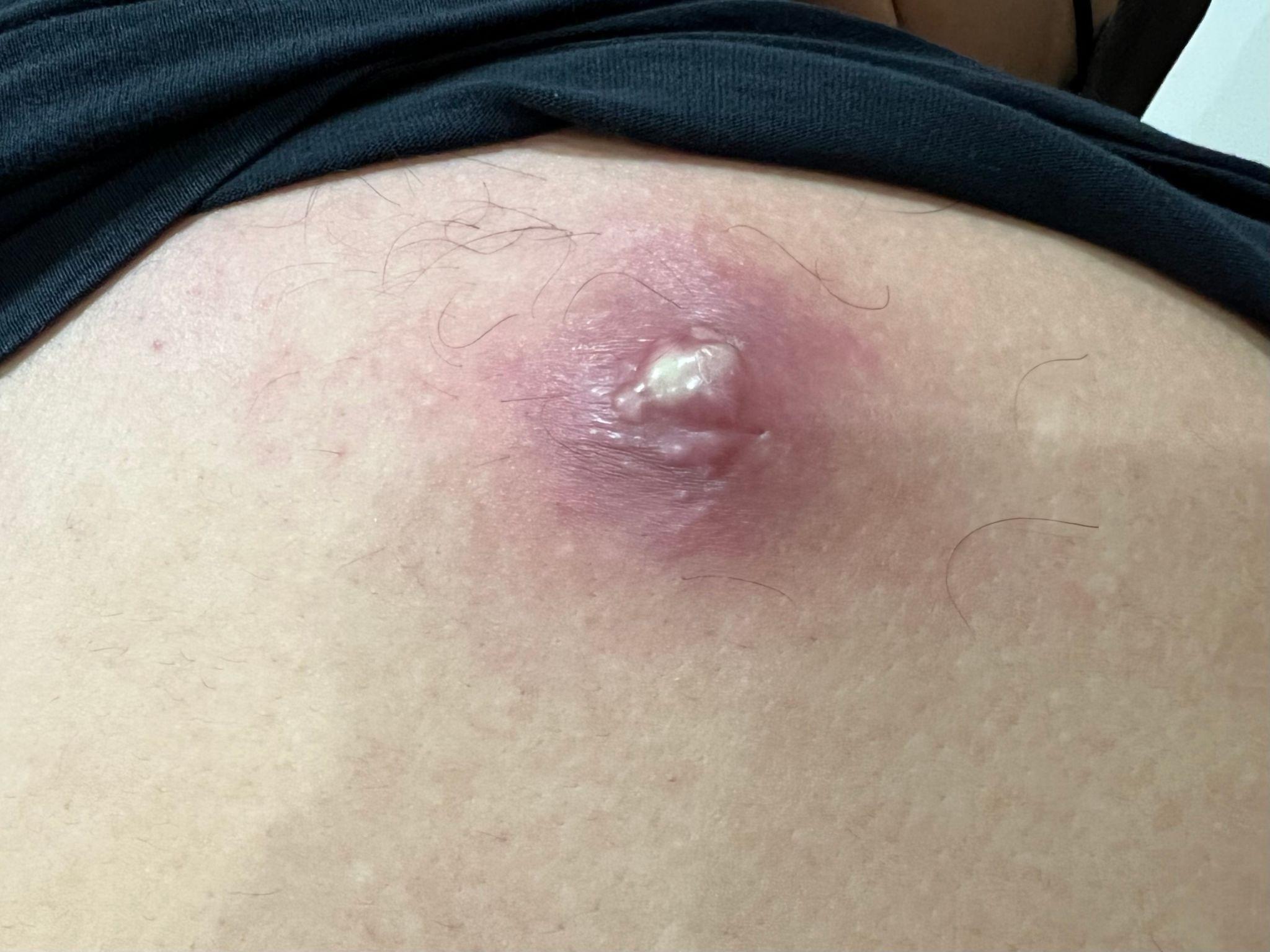Looking for sebaceous cyst treatment in Jabalpur? Dr. Abhineet Jain provides safe surgical removal of sebaceous cyst | Dr. Abhineet Jain (Piles Specialist in Jabalpur) | Best General Surgeon in Jabalpur, Best Laser Surgeon in Jabalpur, General Surgeon in Jabalpur, Laser Surgery in Jabalpur, Laparoscopic Surgeon in Jabalpur - GL120769