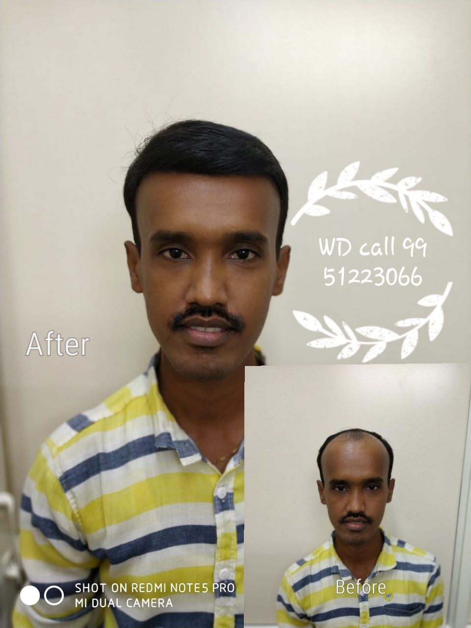 Non - Surgical Hair Replacement in Mahatma Gandhi Road @9951223066 | WIGS  DESIGNS | #nonsurgical #hairbonding #hairfixing -