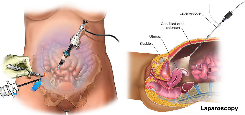 Looking for the best laser piles treatment in Jabalpur? Dr. Abhineet Jain offers advanced, painless laser surgery for hemorrhoids with faster recovery | Dr. Abhineet Jain (Piles Specialist in Jabalpur) | laser piles treatment in jabalpur, piles specialist jabalpur, laser surgeon jabalpur, hemorrhoids treatment, painless piles surgery, piles doctor near me, general surgeon jabalpur, - GL120767