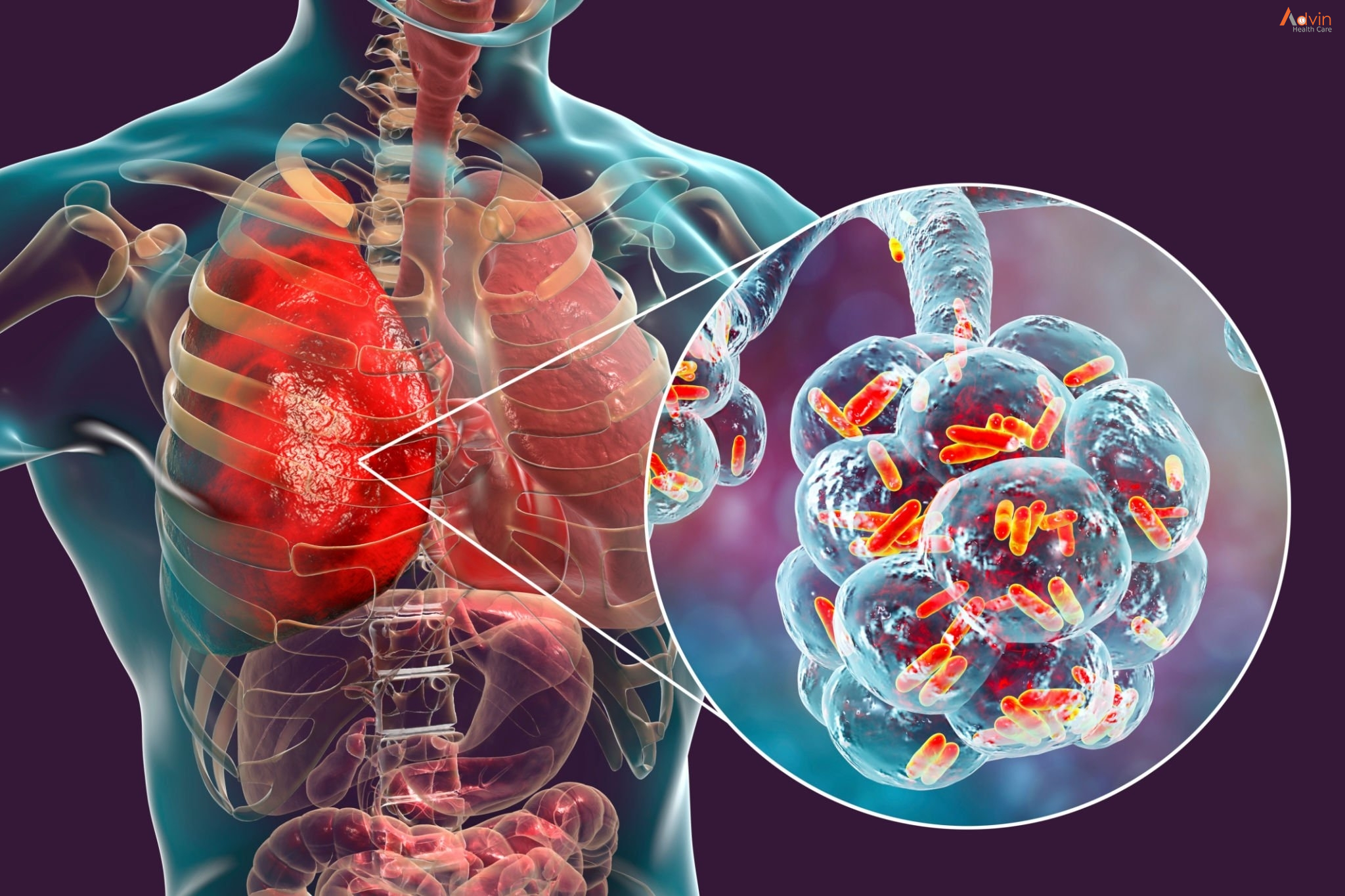 TB Hospital In Jabalpur | Anant Hospital | TB Hospital In Jabalpur, best TB Hospital In Jabalpur, TB treatment Hospital In Jabalpur,  Tb treatment hospital in Jabalpur, Tb doctor in Jabalpur, tuberclosis treatment in jabalpur - GL119762