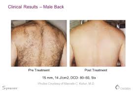 Laser Hair Removal in Zirakpur | Renovin Skin Care | LASER HAIR REMOVAL IN  CHANDIGARH, LASER
