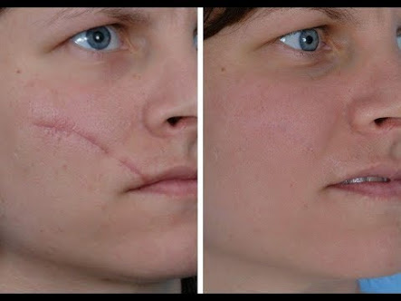 Renovin Skin Care, Scar treatment in Zirakpur, Warts and Corn treatment in Zirakpur, Mole treatment in Zirakpur,  SKIN DOCTOR IN ZIRAKPUR, Skin Doctors in Derabassi, Skin Doctor in Dhakoli, Dermatologist in Baltana