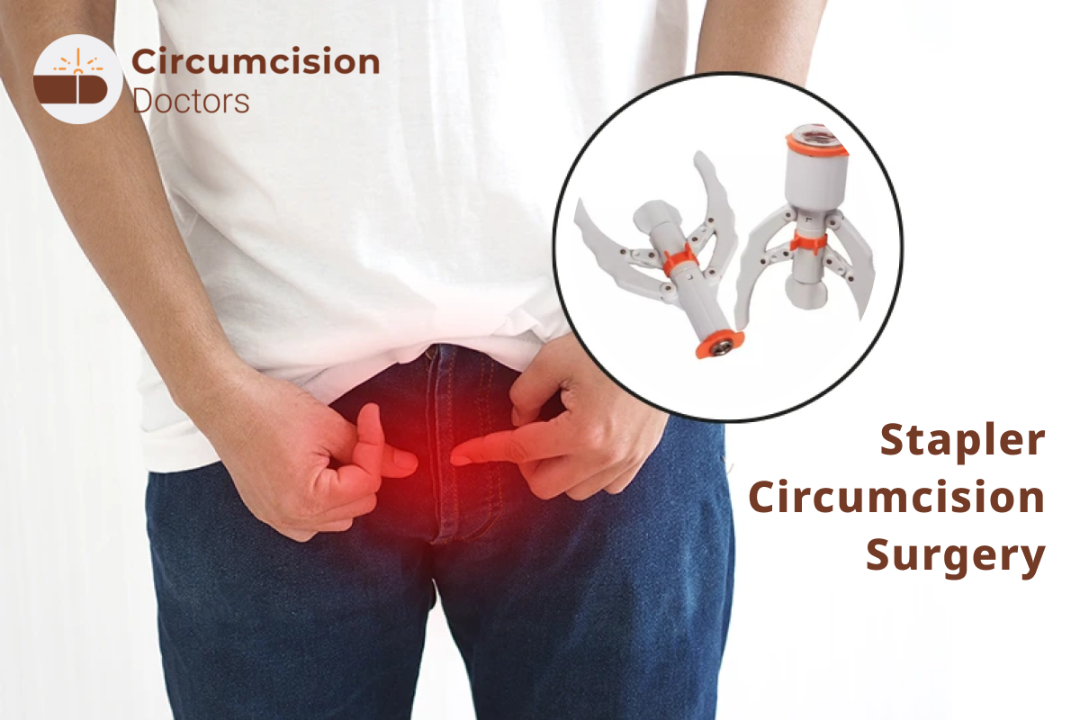 Circumcision Stapler | Dr. Abhineet Jain (Piles Specialist in Jabalpur) | Circumcision Stapler doctor in Jabalpur, Circumcision Stapler surgeon in Jabalpur,  best Circumcision Stapler doctor in Jabalpur, best Circumcision Stapler surgeon in Jabalpur, - GL115100
