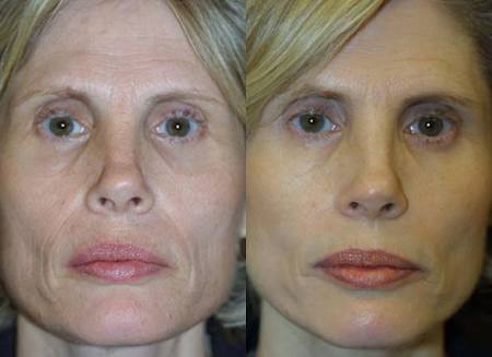 Renovin Skin Care, Antiageing treatment in Zirakpur, Skin specialist in Zirakpur, Dermatologist in Zirakpur, Skin Clinic in Zirakpur, SKIN DOCTOR IN ZIRAKPUR, SKIN specialist in Chandigarh, Dermatologist in Dhakoli