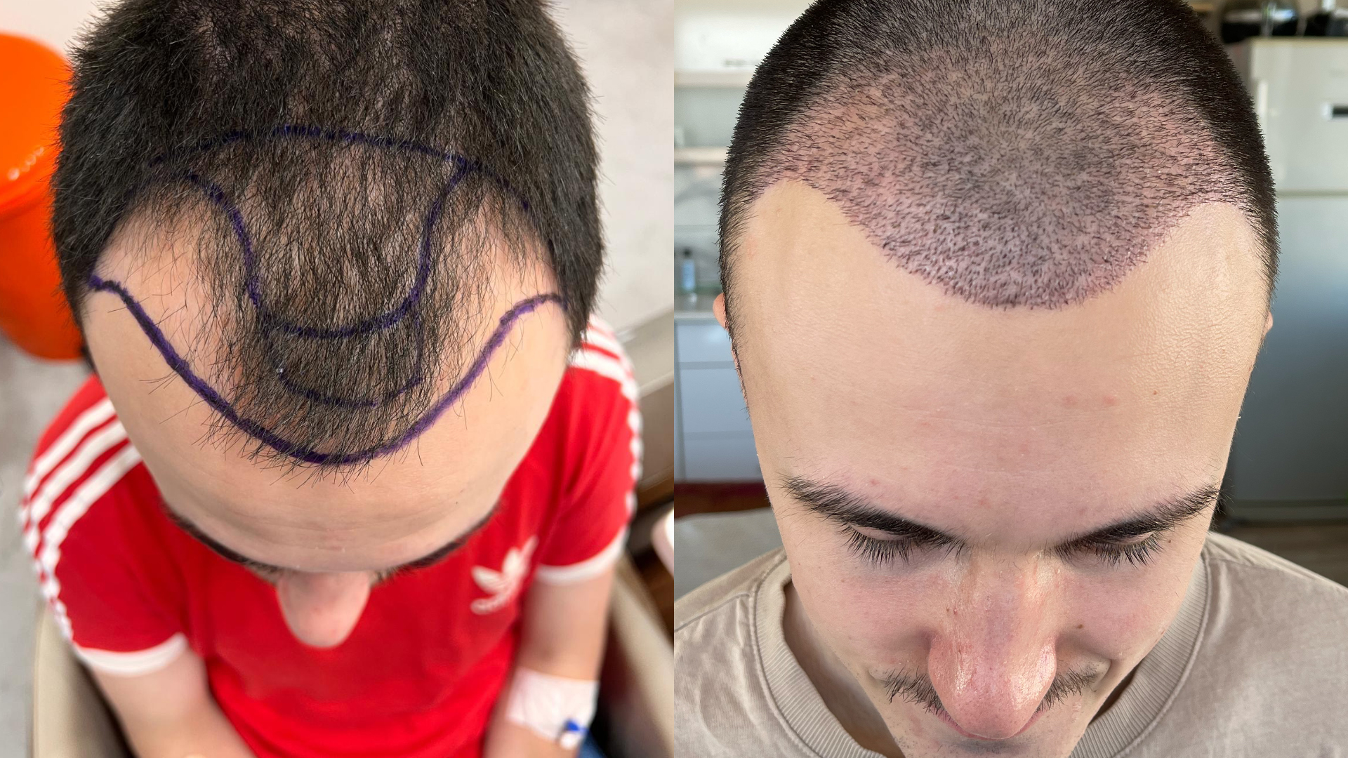 Hair Transplant is a medical procedure used to treat hair loss | Elegance Skin And Gynae Clinic | hair transplant treatment in jabalpur, best hair transplant clinic in jabalpur, jabalpur best hair transplant doctor in jabalpur, best hair transplant center in jabalpur - GL120136
