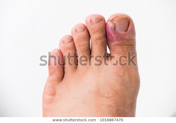 Ingrown Toe nail treatment in Zirakpur | Renovin Skin Care | Ingrown Toe nail treatment in Zirakpur, Dermatologist in Zirakpur, Skin specialist in Baltana, Skin specialist in Dera Bassi, Dermatologist in Derabassi, Skin Doctor in Baltana - GL84334