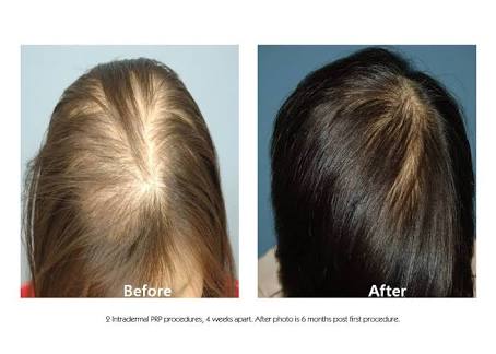 Renovin Skin Care, PRP TREATMENTS IN ZIRAKPUR, DERMATOLOGIST IN ZIRAKPUR, SKIN DOCTOR IN ZIRAKPUR, SKIN SPECIALIST IN ZIRAKPUR, SKIN SPECIALIST ON VIP ROAD ZIRAKPUR, DERMATOLOGIST IN VIP ROAD ZIRAKPUR, SKIN DOCTOR IN VI