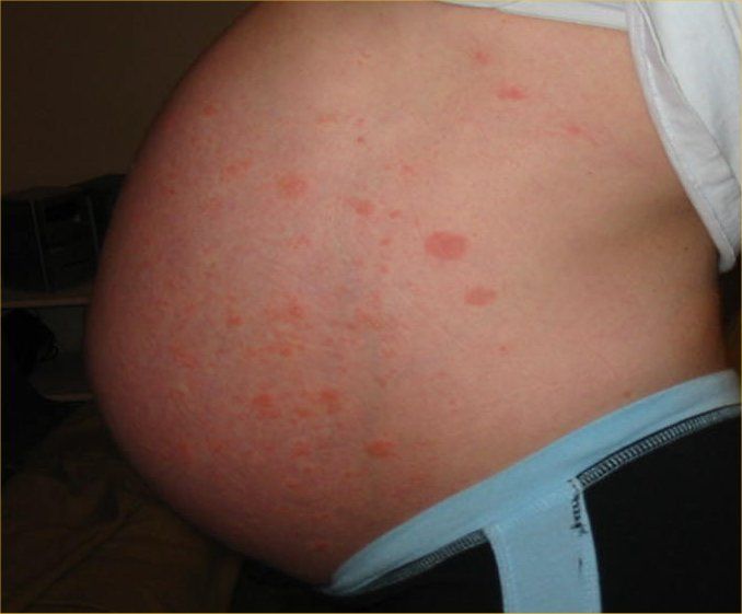 Renovin Skin Care, Pregnancy and Skin diseases