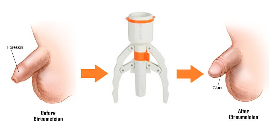 ZSR Circumcision Stapler | Dr. Abhineet Jain (Piles Specialist in Jabalpur) | ZSR Circumcision Stapler doctor in Jabalpur, ZSR Circumcision Surgeon doctor in Jabalpur, best ZSR Circumcision Stapler doctor in Jabalpur, best ZSR Circumcision Stapler surgeon in Jabalpur,  - GL115102