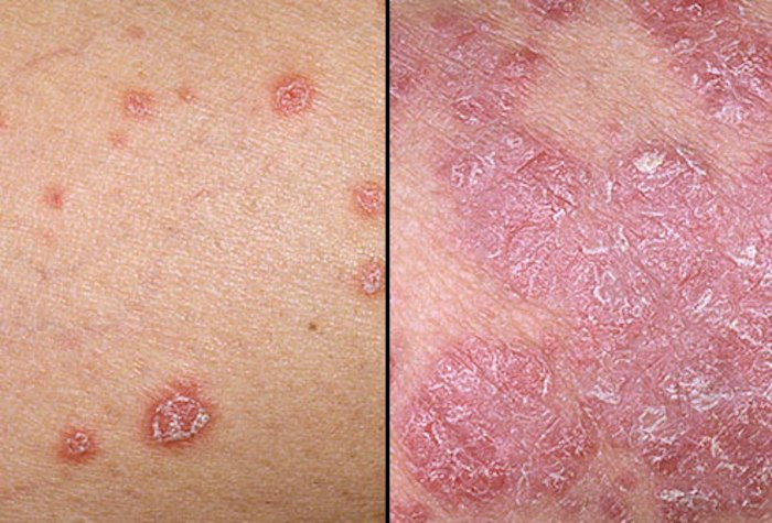 Renovin Skin Care, Psoriasis treatment in Zirakpur, Psoriasis and Eczema Doctor in zirakpur, Skin specialist in Derabassi, Dermatologist in Dhakoli, Tattoo removal in Zirakpur, Moles and warts removal in Zirakpur