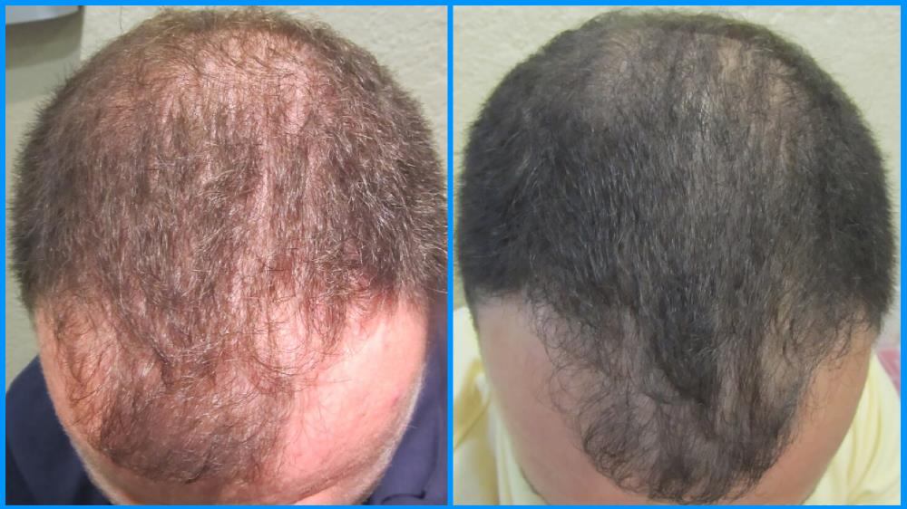 Renovin Skin Care, PRP treatment in Zirakpur, PRP treatment in Chandigarh, PRP treatment in Derabassi, PRP treatment in Mohali, Allergy Doctor in zirakpur, Allergy testing in Zirakpur, Allergy clinic in Zirakpur
