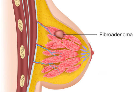 Fibroadenoma of Breast Specialist Doctor in Jabalpur &ndash; Dr. Abhineet Jain | Dr. Abhineet Jain (Piles Specialist in Jabalpur) | ibroadenoma in breast, fibroadenoma doctor in Jabalpur, fibroadenoma specialist in Jabalpur, breast fibroadenoma treatment Jabalpur, fibroadenoma treatment in Jabalpur, breast lump doctor in Jabalpur - GL121172