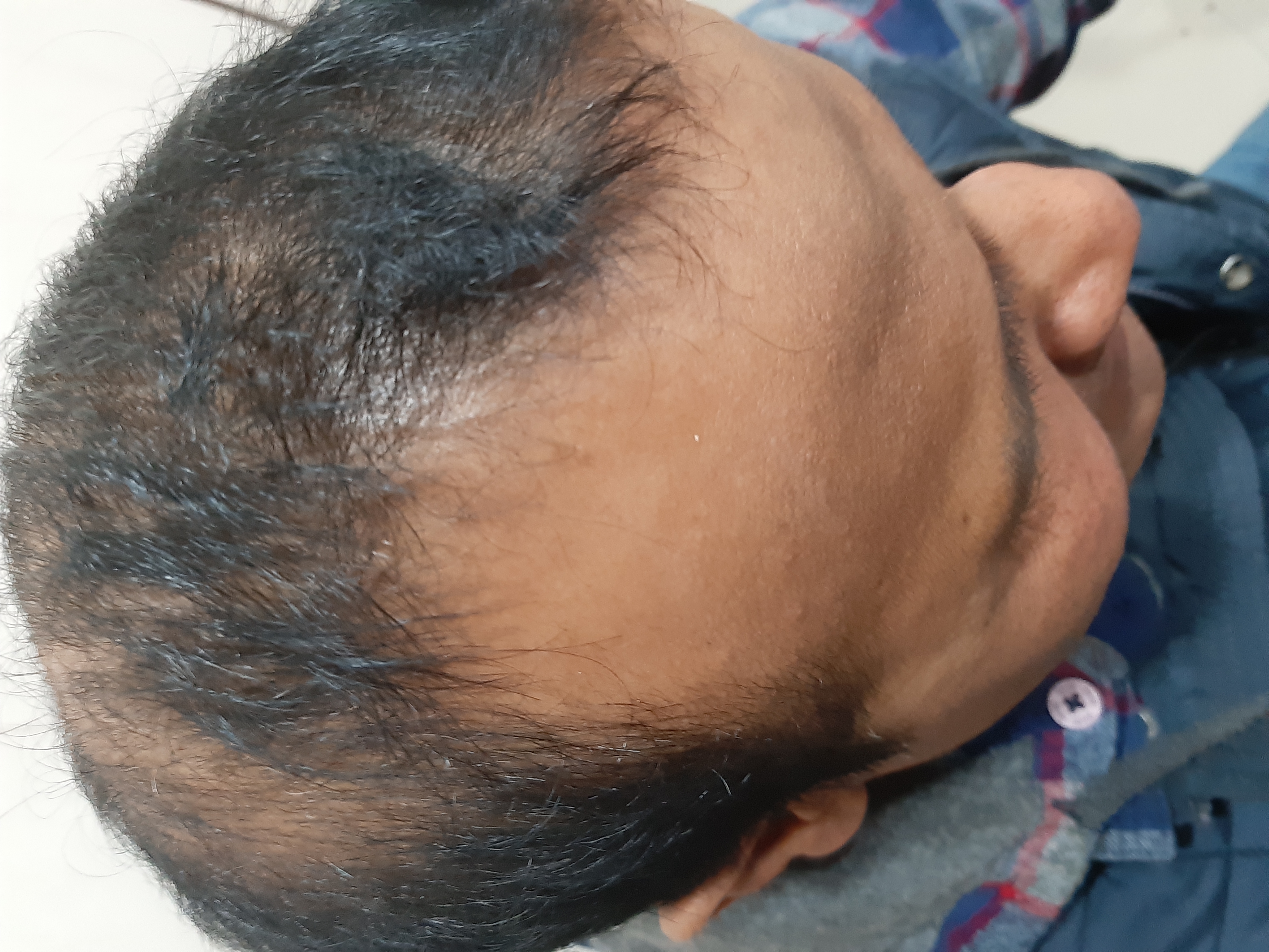 Renovin Skin Care, Hair Fall treatment in Zirakpur, Hair loss treatment in Zirakpur, Hair transplant in Zirakpur, PRP treatments in Zirakpur, Dermatologist in Dera Bassi, Hair specialist on VIP Road zirakpur
