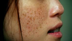 Livglam Anti Ageing Clinics, freckles  black spots skin tags brown spots dark spots sun tan skin tan 