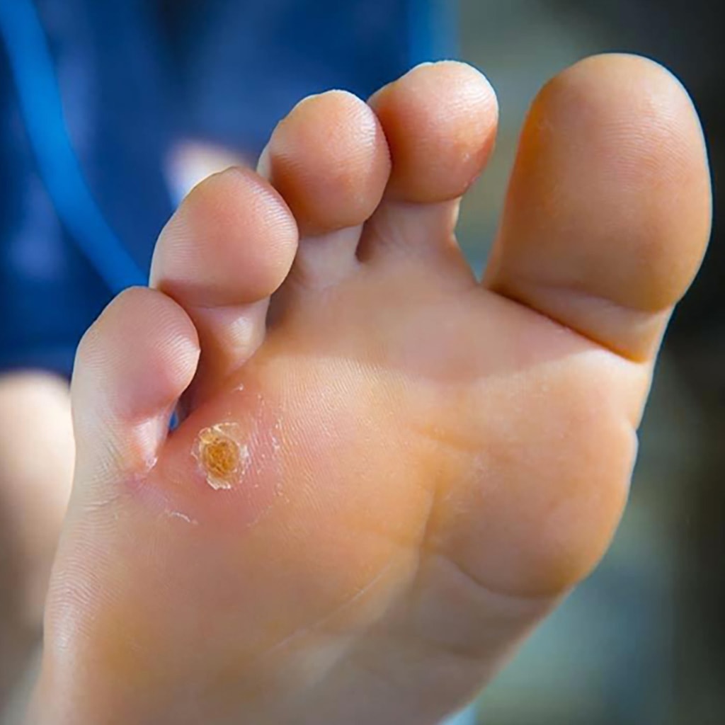 Corns and calluses - Diagnosis and treatment | Dr. Abhineet Jain (Piles Specialist in Jabalpur) | corn treatment doctor in Jabalpur, best corn treatment doctor in jabalpur, corn treatment  specialist in Jabalpur, best corn treatment  specialist in Jabalpur, - GL116802