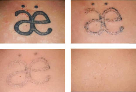 Renovin Skin Care, Laser Tatoo removal In Zirakpur
Skin specialist in Zirakpur
Skin Doctor Near me
Dermatologist in Zirakpur
Skin specialist near me