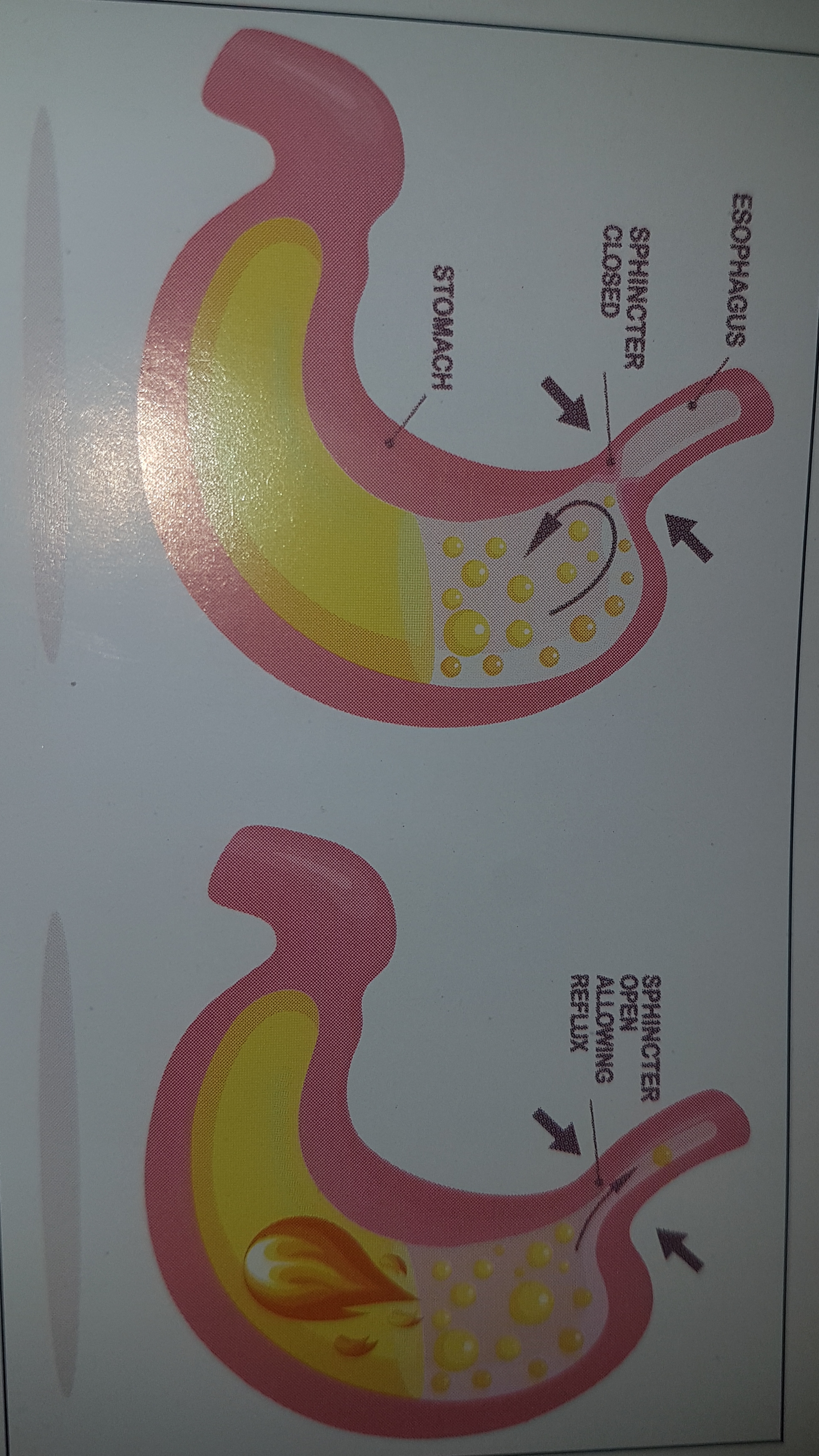 Role of Diet in Gastroesophalgeal Reflux Disease.   | Tejasvini Kerala Ayurveda | Gerd treatment in tricity,  Gerd treatment in मोहाली,  Gerd treatment in Mohali,  Gerd treatment in Chandigarh  - GL80709