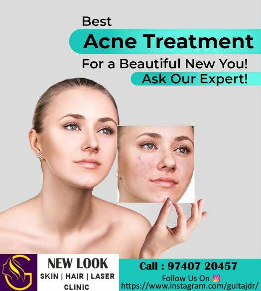 New Look SkinHair Laser Clinic, Best Acne Treatment in Indiranagar, Acne Treatment in Indiranagar, Best Skin Treatment in Indiranagar