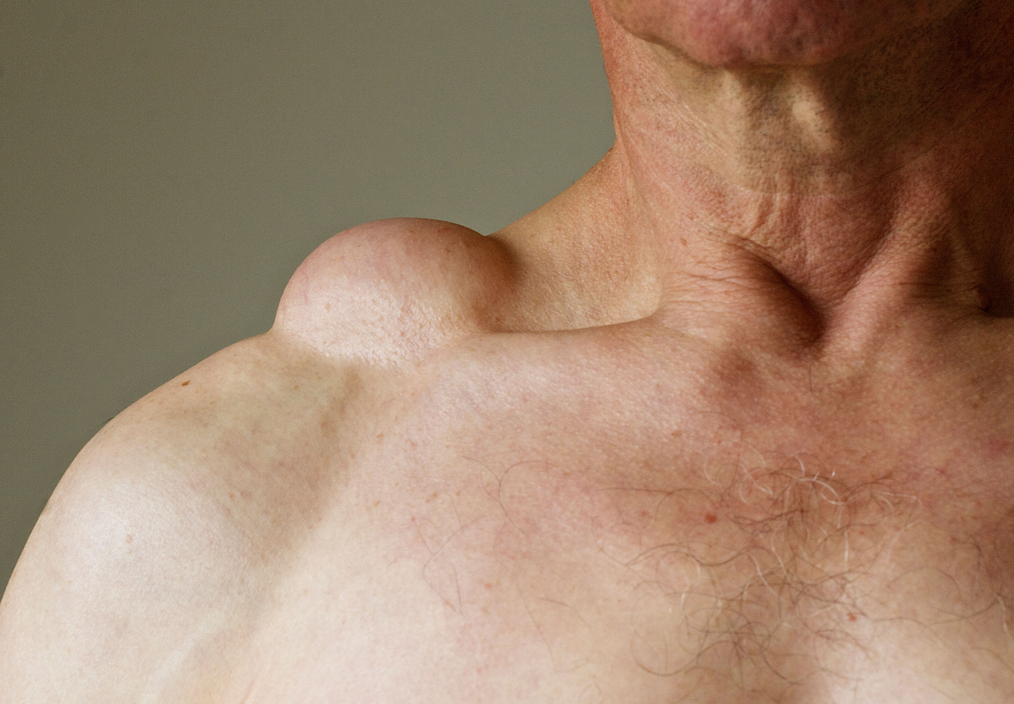 When it comes to the treatment of lipoma- Dr. Abhineet Jain is regarded as one of the most reliable doctor for Lipoma in Jabalpur | Dr. Abhineet Jain (Piles Specialist in Jabalpur) | doctor for Lipoma in Jabalpur, best doctor for Lipoma in Jabalpur, surgeon for Lipoma in Jabalpur, treatment for Lipoma in Jabalpur, best clinic for Lipoma in Jabalpur,  - GL120313