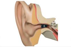 DANDEKAR HEARING SERVICES, HEARING, PUNE, HEARING PUNE, HEARING IN PUNE, HEARING AID IN PUNE, HEARING AIDS IN PUNE, HEARING AID DEALERS IN PUNE, HEARING AIDS DEALERS IN PUNE, HEARING CLINIC IN PUNE,HEARING DOCTORS IN PUNE,BEST.