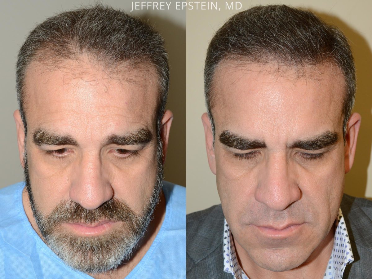 Laser Hair Removal Treatment In Males Mobile No 9876931601 By