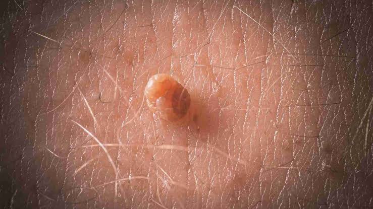 Genital Warts Specialist Doctor in Jabalpur &ndash; Dr. Abhineet Jain | Dr. Abhineet Jain (Piles Specialist in Jabalpur) | genital warts specialist in Jabalpur, genital warts doctor in Jabalpur, best genital warts doctor in Jabalpur, genital wart treatment in Jabalpur, genital warts treatment Jabalpur, HPV doctor in Jbp - GL121170