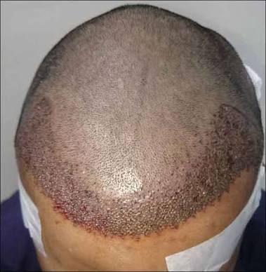 Renovin Skin Care, Hair Transplant Doctor in Zirakpur and Chandigarh