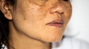 Pigmentation is the natural coloring of the skin, hair, and eyes, primarily determined by the presence of a pigment called melanin. | Elegance Skin And Gynae Clinic | pigmentation treatment in jabalpur, best pigmentation treatment in jabalpur, pigmentation skin clinic in jabalpur, pigmentation treatment clinic in jabalpur, pigmentation treatment dr in jabalpur, - GL120182