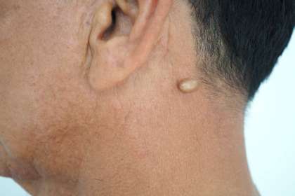 Dr. Abhineet Jain (Piles Specialist in Jabalpur),  epidermoid cyst in Jabalpur, best  epidermoid cyst in Jabalpur,  epidermoid cyst doctor in Jabalpur,  epidermoid cyst specialist in Jabalpur, top  epidermoid cyst in Jabalpur