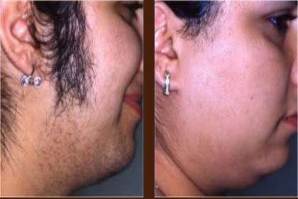 Renovin Skin Care, Laser Hair removal in Zirakpur, Dermatologist in Derabassi, Skin clinic in Zirakpur
