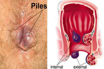 Dr. Abhineet Jain (Piles Specialist in Jabalpur), the best doctors in Jabalpur for piles (hemorrhoids) 