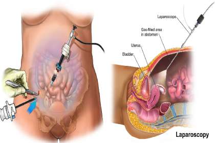 Dr. Abhineet Jain (Piles Specialist in Jabalpur), laser piles treatment in jabalpur, piles specialist jabalpur, laser surgeon jabalpur, hemorrhoids treatment, painless piles surgery, piles doctor near me, general surgeon jabalpur,