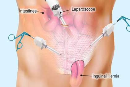 Dr. Abhineet Jain (Piles Specialist in Jabalpur), Hernia Treatment Jabalpur, Hernia Surgeon Jabalpur, Laparoscopic Surgery in jabalpur