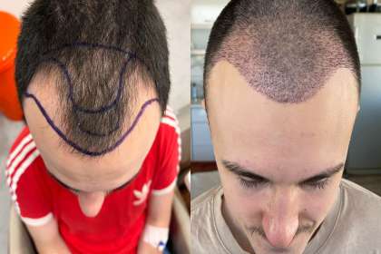 Elegance Skin And Gynae Clinic, hair transplant treatment in jabalpur, best hair transplant clinic in jabalpur, jabalpur best hair transplant doctor in jabalpur, best hair transplant center in jabalpur