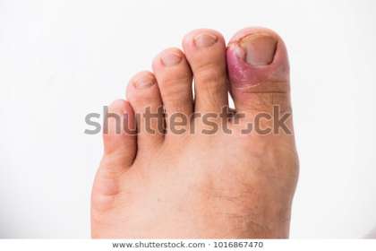 Renovin Skin Care, Ingrown Toe nail treatment in Zirakpur, Dermatologist in Zirakpur, Skin specialist in Baltana, Skin specialist in Dera Bassi, Dermatologist in Derabassi, Skin Doctor in Baltana