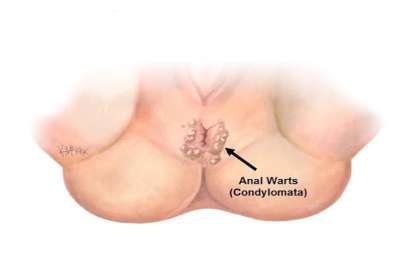 Dr. Abhineet Jain (Piles Specialist in Jabalpur), anal warts specialist in Jabalpur, anal warts doctor in Jabalpur, best anal warts doctor in Jabalpur, anal wart treatment in Jabalpur, anal warts treatment Jabalpur, anal wart specialist Jabalpur