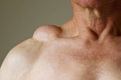 Dr. Abhineet Jain (Piles Specialist in Jabalpur), doctor for Lipoma in Jabalpur, best doctor for Lipoma in Jabalpur, surgeon for Lipoma in Jabalpur, treatment for Lipoma in Jabalpur, best clinic for Lipoma in Jabalpur, 