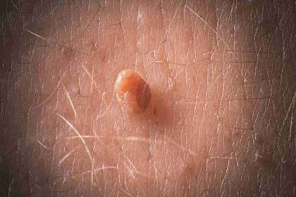 Dr. Abhineet Jain (Piles Specialist in Jabalpur), genital warts specialist in Jabalpur, genital warts doctor in Jabalpur, best genital warts doctor in Jabalpur, genital wart treatment in Jabalpur, genital warts treatment Jabalpur, HPV doctor in Jbp